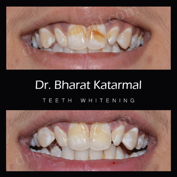 Slider image (2) Dr. Bharat Katarmal Dental and Implant Clinic